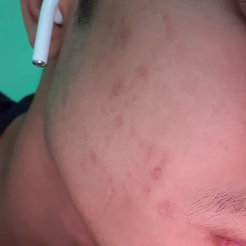 Get Pickelmale Schnell Loswerden Hausmittel Gif