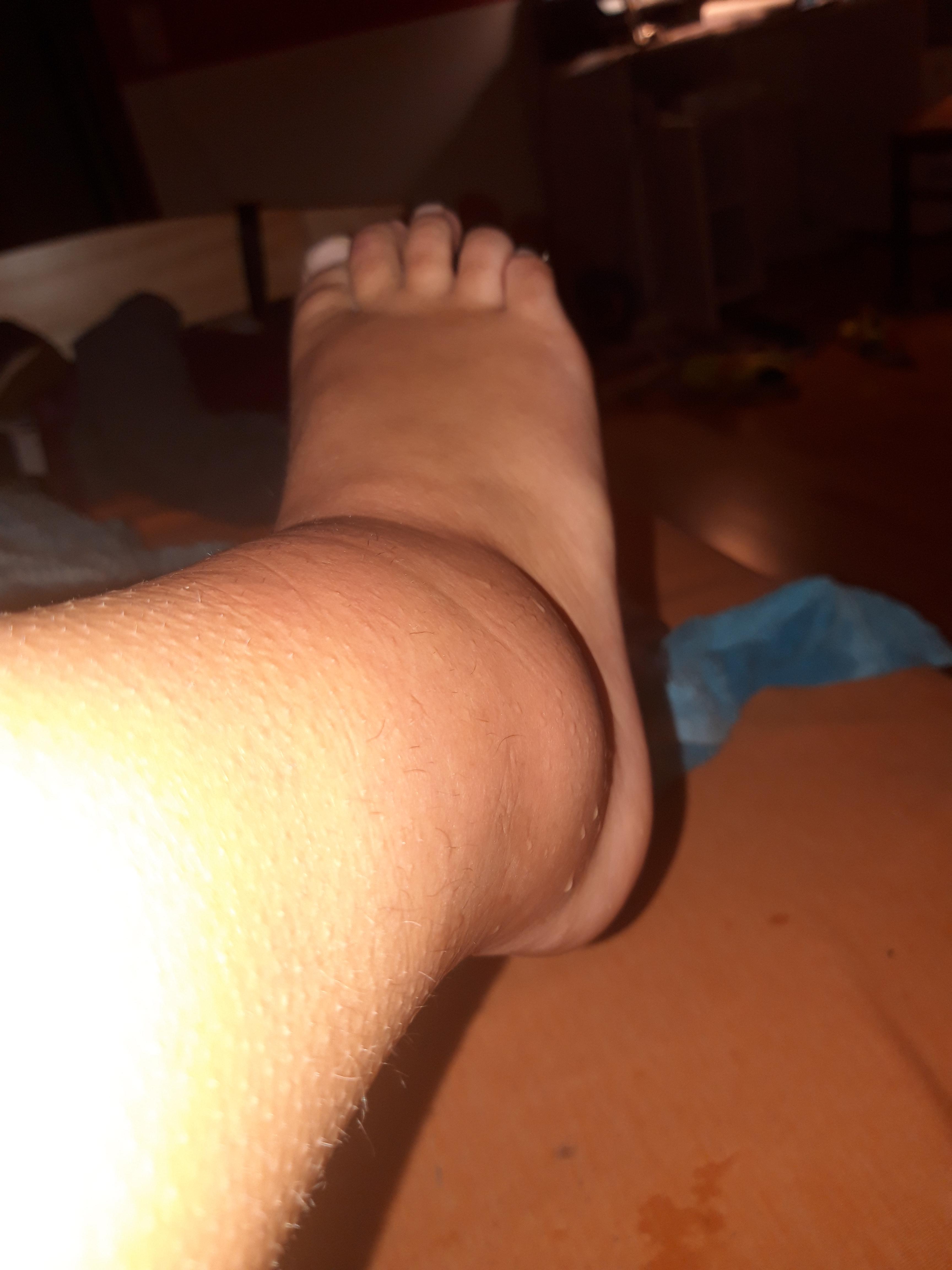 Wie Lange Krucken Nach Einem Banderriss Gesundheit Und Medizin Aircast Wie Lange Krucken Nach Einem Banderriss Gesundheit Und Medizin Aircast