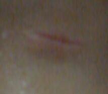 - (Gesundheit, Narben, Wunde)