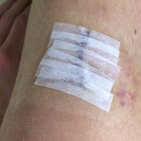 Wie Lange Pflaster Auf Naht Lassen Medizin Operation Wie Lange Pflaster Auf Naht Lassen Medizin Operation