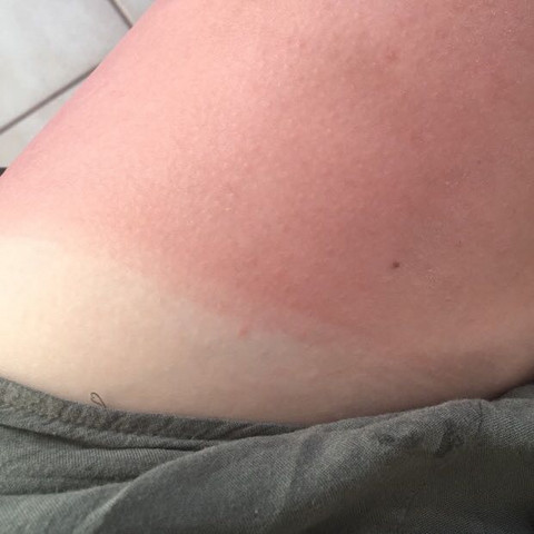 Wie Lange Wird Der Sonnenbrand Dauern Und Wann Hort Der Schmerz Auf Gesundheit Und Medizin Schmerzen Haut Wie Lange Wird Der Sonnenbrand Dauern Und Wann Hort Der Schmerz Auf Gesundheit Und Medizin Schmerzen Haut