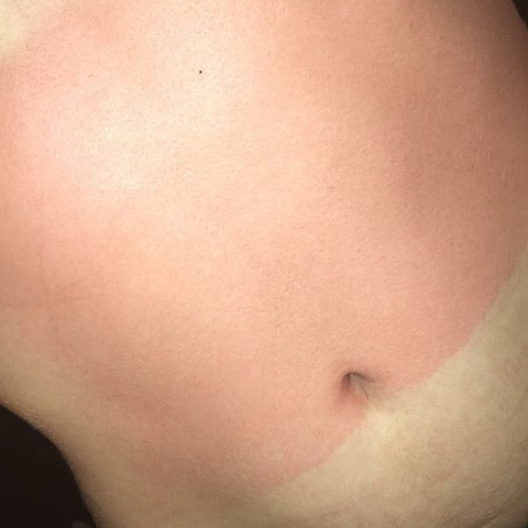 Wie Lange Wird Der Sonnenbrand Dauern Und Wann Hort Der Schmerz Auf Gesundheit Und Medizin Schmerzen Haut Wie Lange Wird Der Sonnenbrand Dauern Und Wann Hort Der Schmerz Auf Gesundheit Und Medizin Schmerzen Haut