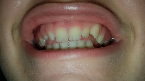 Zähne - (Zähne, Zahnspange)