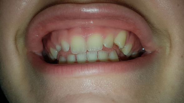 Wie Lange Zahnspange Fur Diese Zahne Wie Lange Zahnspange Fur Diese Zahne