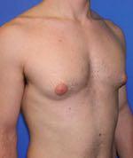 Brust Mann Mensch Pubertät Brustwarze 
 - (Pubertät, Brust, Gynäkomastie)