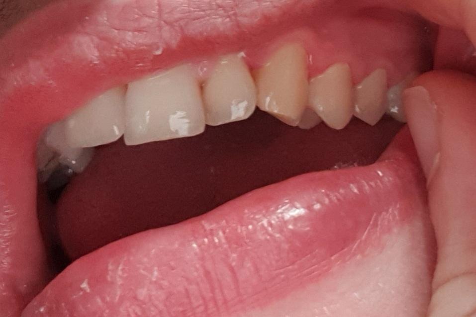 Wie man sieht ist oben rechts das Zahnfleisch leicht rot und am Zahn. Was kann ich dagegen tun