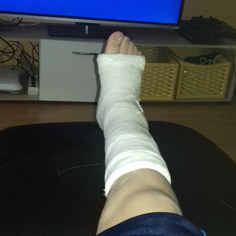 Krücken gipsbein Alexandra Footage