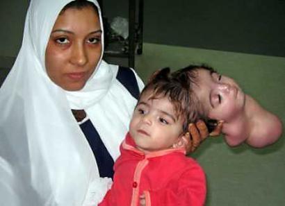 Wie Nennt Man Siamesische Zwillinge Welche Zwei Kopfe Haben Aber Nur Einer Den Korper Bewegen Kann Medizin Baby Kopf Wie Nennt Man Siamesische Zwillinge Welche Zwei Kopfe Haben Aber Nur Einer Den Korper Bewegen Kann Medizin Baby Kopf