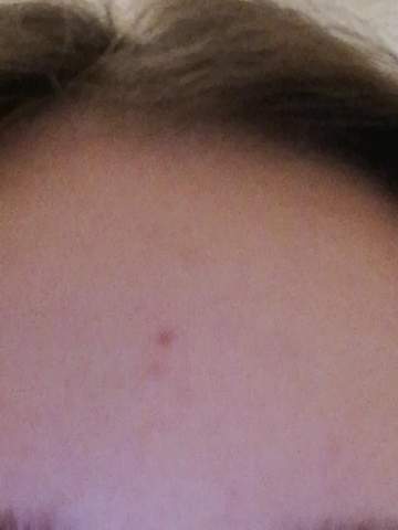 Wie Oder Wann Geht Dieser Pickel Weg Wegbekommen