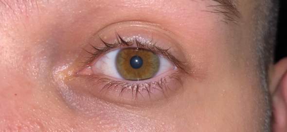 Wie oft treten zwei verschiedene Farben in einem Auge auf? Gibt es irgendwo einen Artikel dazu?