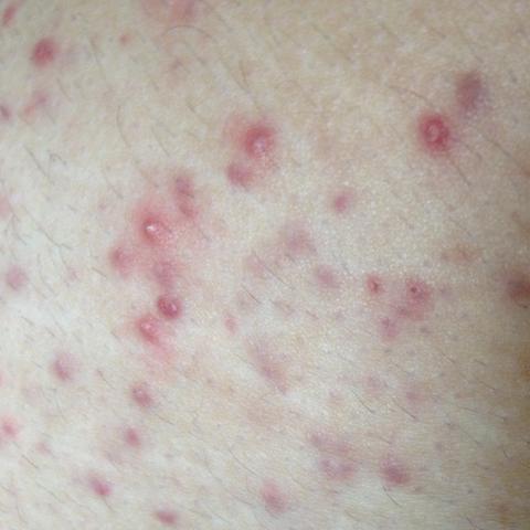 Wie Pickel Am Po Nach Der Rasur Entfernen Gesundheit Beauty Haut Wie Pickel Am Po Nach Der Rasur Entfernen Gesundheit Beauty Haut