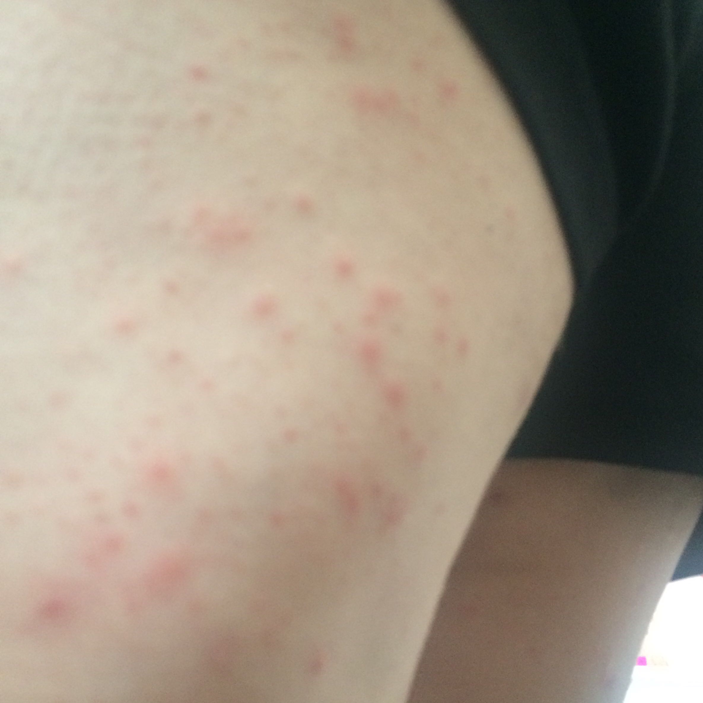 Wie Pickel an Oberschenkel wegbekommen? (Hygiene, Akne) pickel an oberschenkel