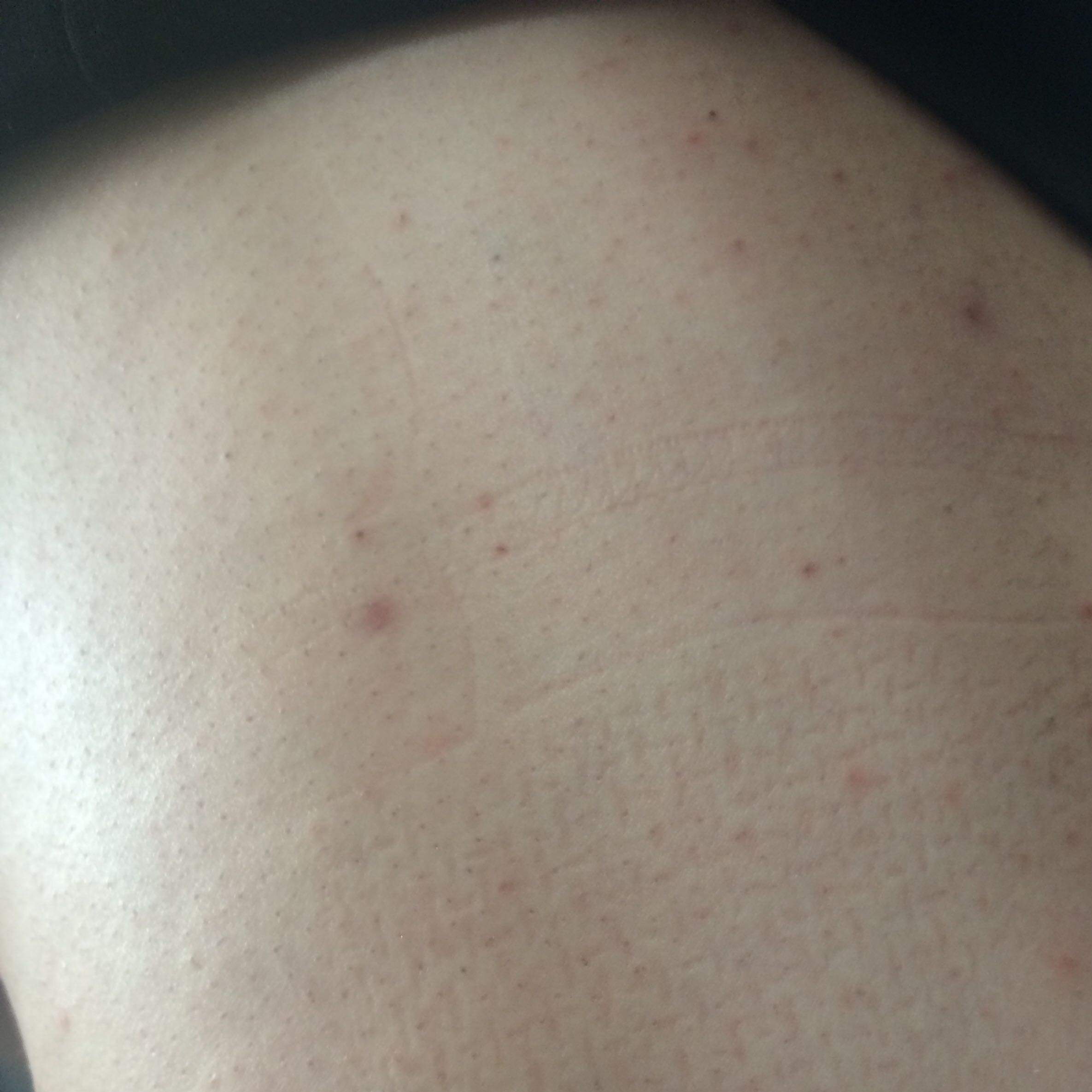 pickel am po und oberschenkel