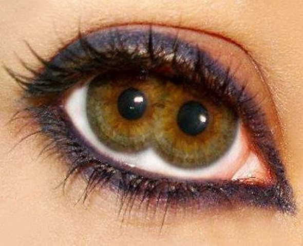 double pupil eye