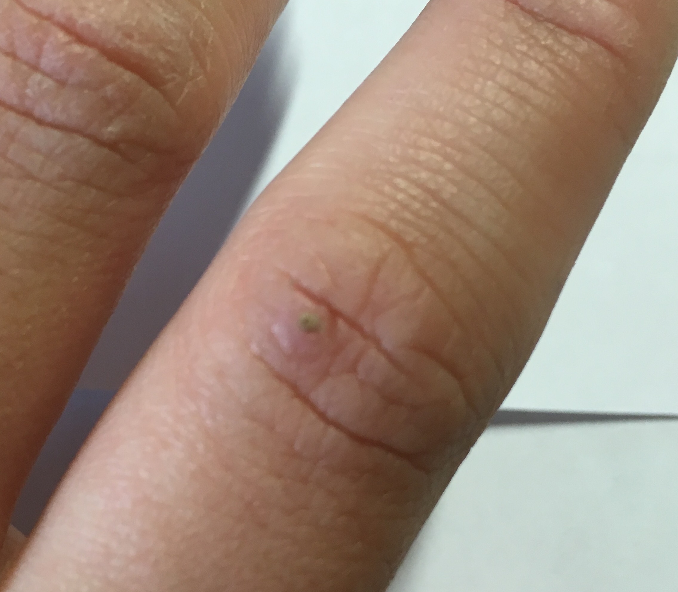 Wie sehen Warzen aus? (Hand) Wie sehen Warzen aus? (Hand)