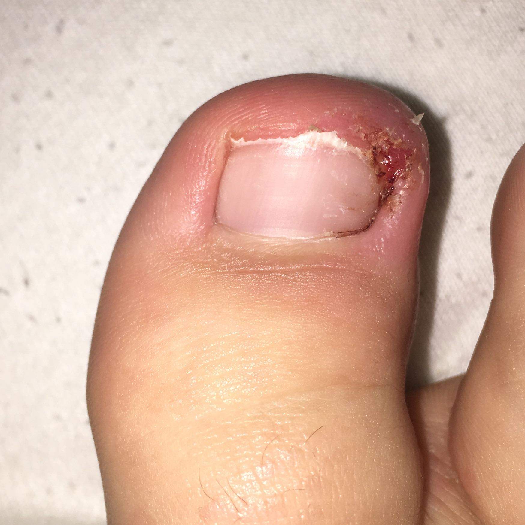 Wie seht ihr das, Entzündung im zeh..? (Gesundheit und Medizin, Arzt Wie seht ihr das, Entzündung im zeh..? (Gesundheit und Medizin, Arzt