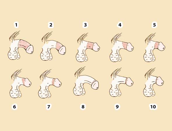 Am Penis beschnitten worden, wie sieht das bei euch danach aus? (Jungs, Sexualitt, Selbstbefriedigung) Am Penis beschnitten worden, wie sieht das bei euch danach aus? (Jungs, Sexualitt, Selbstbefriedigung)
