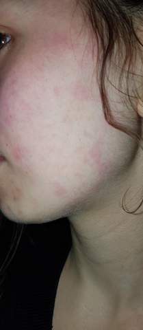 Hautausschlag hiv Skin rash: