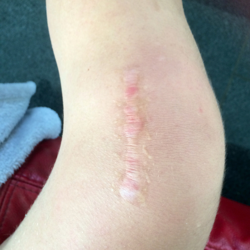 Wie sieht meine narbe am knie aus? (Operation, Narben) Wie sieht meine narbe am knie aus? (Operation, Narben)