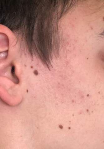 wie soll ich diese menge muttermale