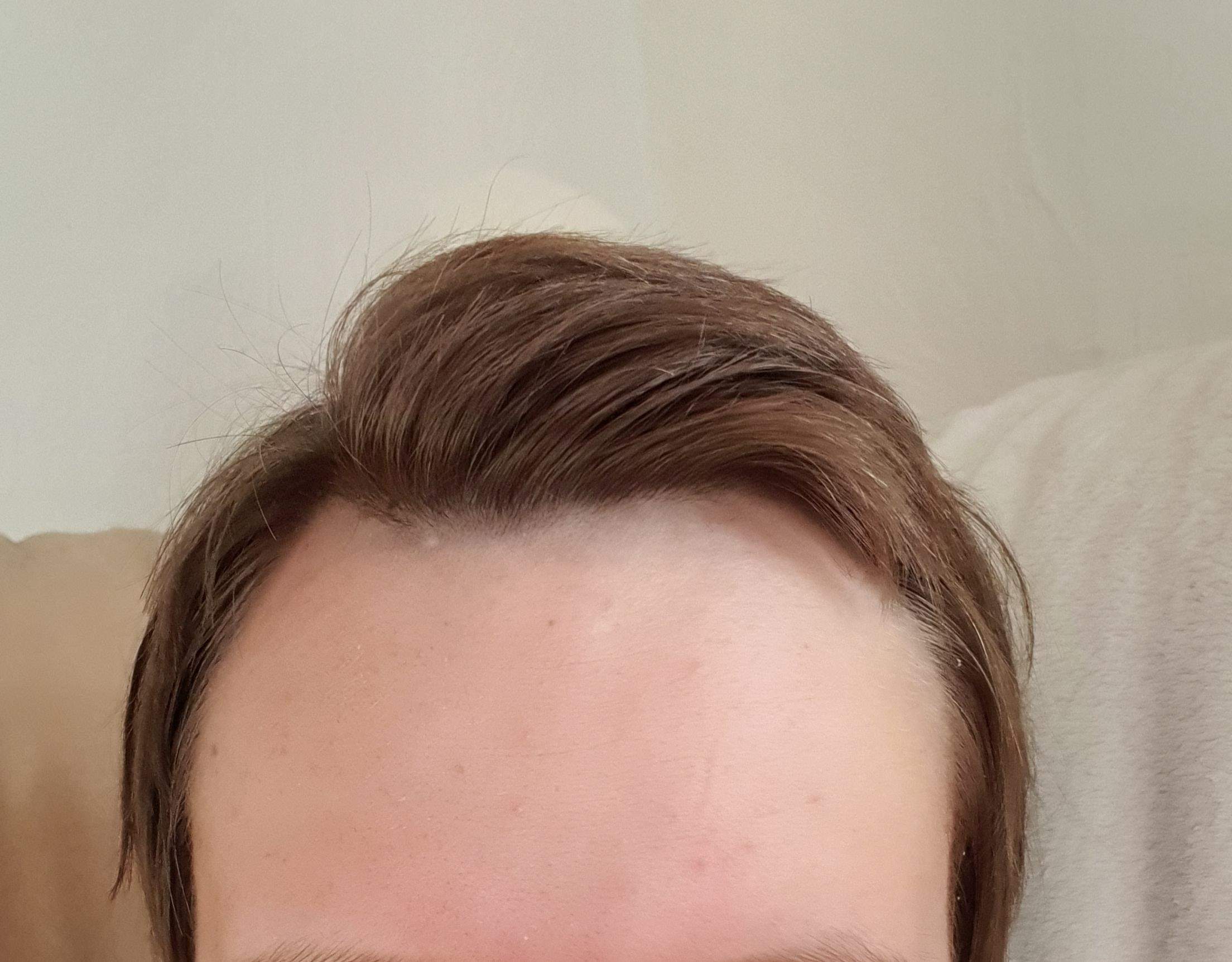 Wie soll ich meine haare schneiden lassen habe auch haarausfall bin ein mädchen? (Friseurin)