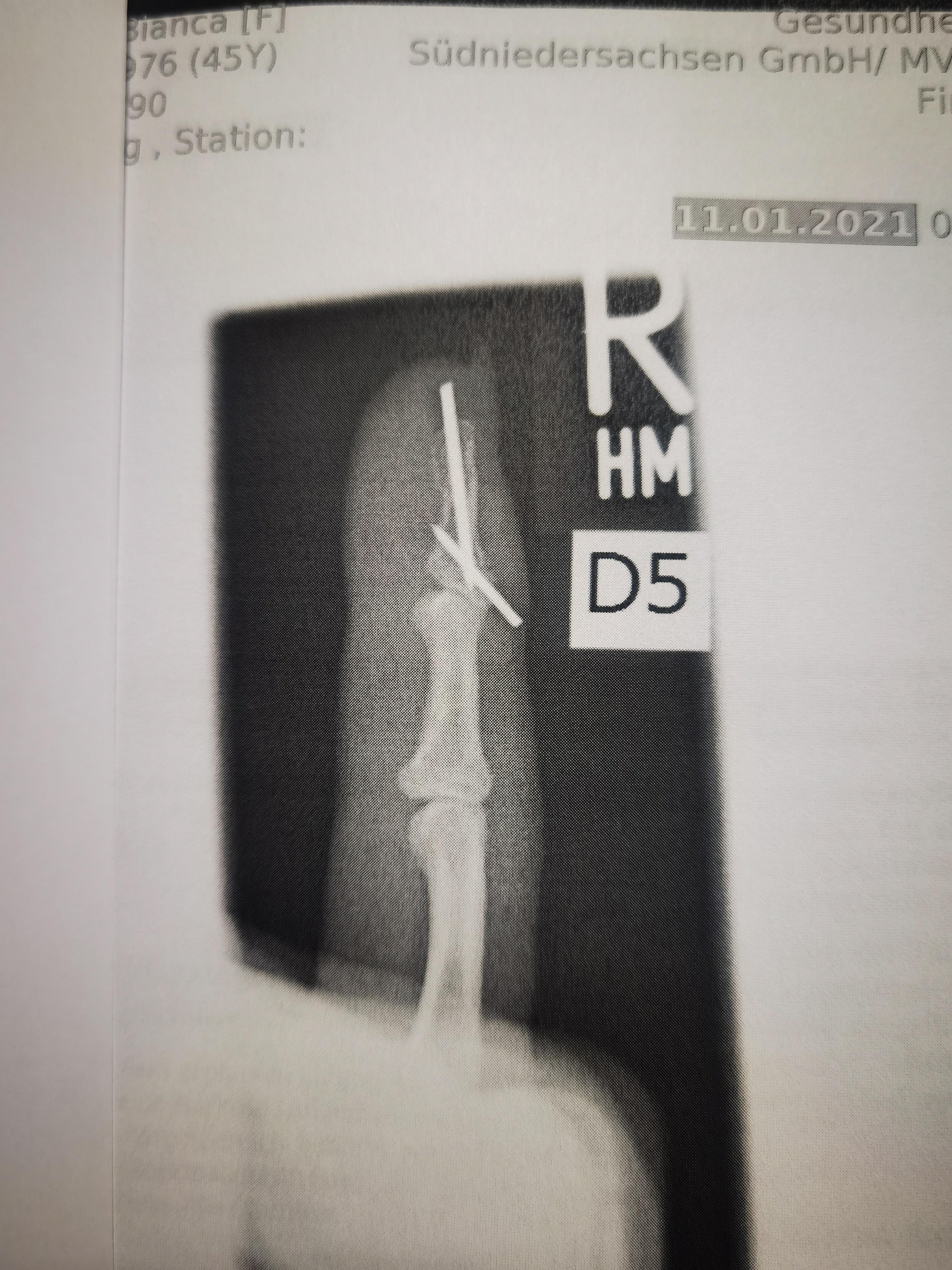 Wie Stabil Ist Der Finger Nachdem Draht Gezogen Wird Gesundheit Und Medizin Wie Stabil Ist Der Finger Nachdem Draht Gezogen Wird Gesundheit Und Medizin