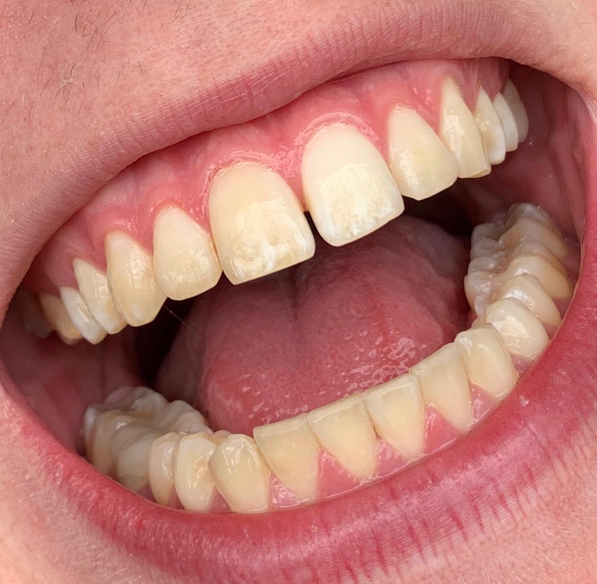 Wie Teuer Sind Veneeers Fur Die Gesamte Zahnreihe Geld Kosten Zahne