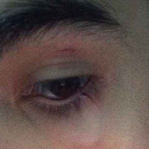 Verletzung an Auge  - (Augen, Verletzung, Wunde)