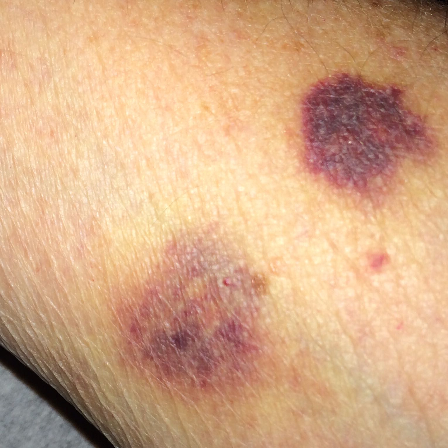 Wie vermeide ich blutunterlaufende Stellen an Armen nach Stößen? (Verletzung, eingeklemmt, Stoß)