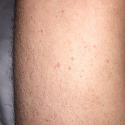 Wie werd ich diese Pickel los? (Gesundheit, Haut, Rötung) pickel auf dem oberschenkel