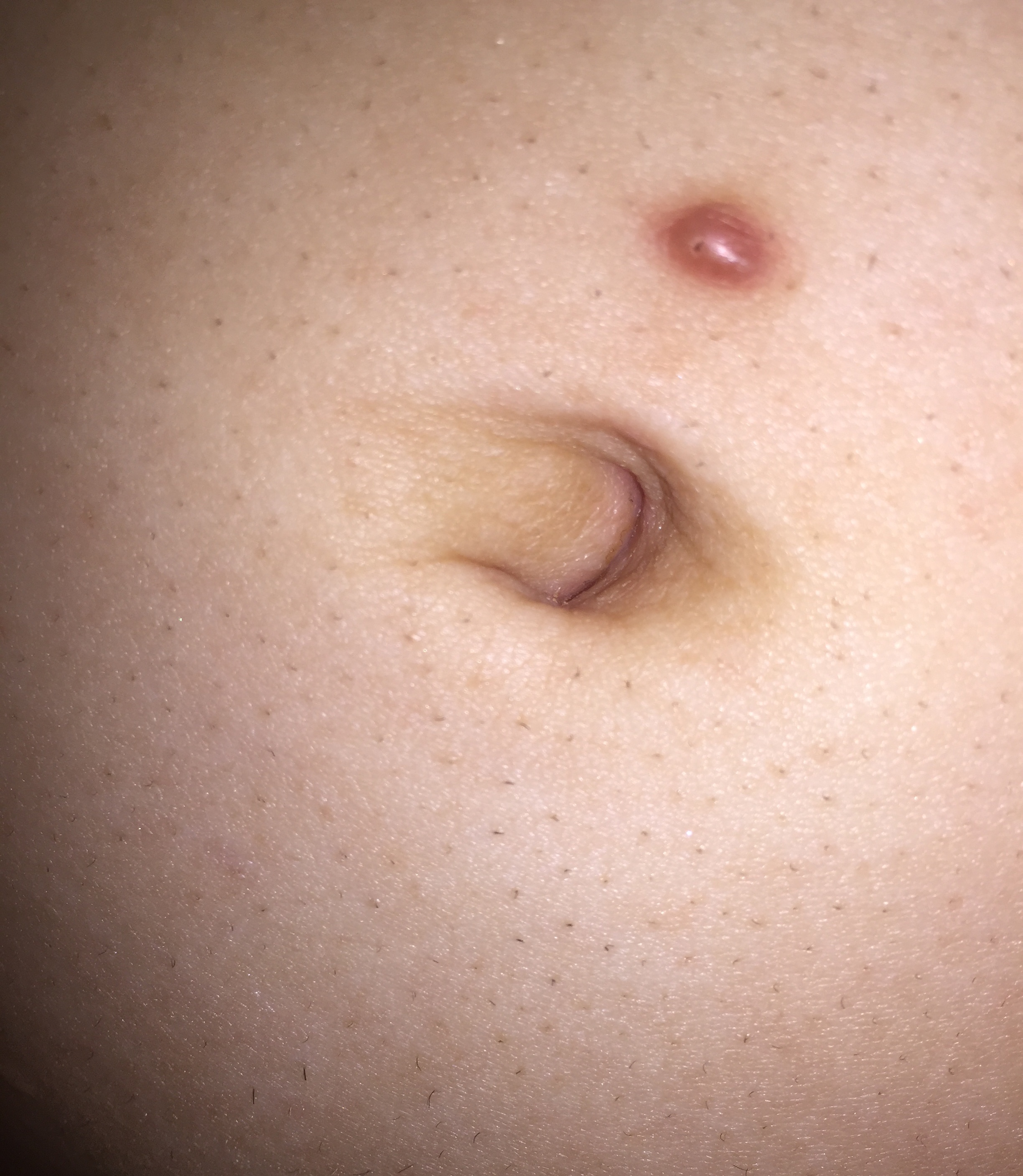 Wie Werde Ich Diese Beule Blase Los Gesundheit Und Medizin Gesundheit Korper Wie Werde Ich Diese Beule Blase Los Gesundheit Und Medizin Gesundheit Korper