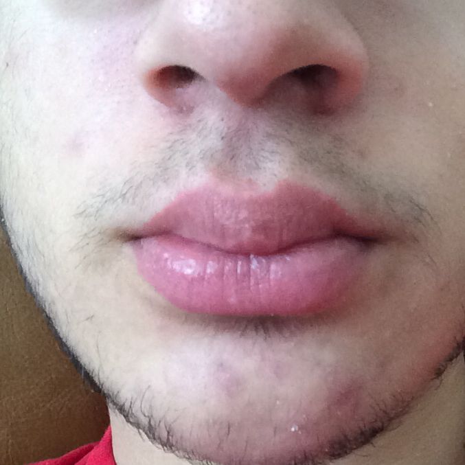 pickel auf kinn pickel auf kinn