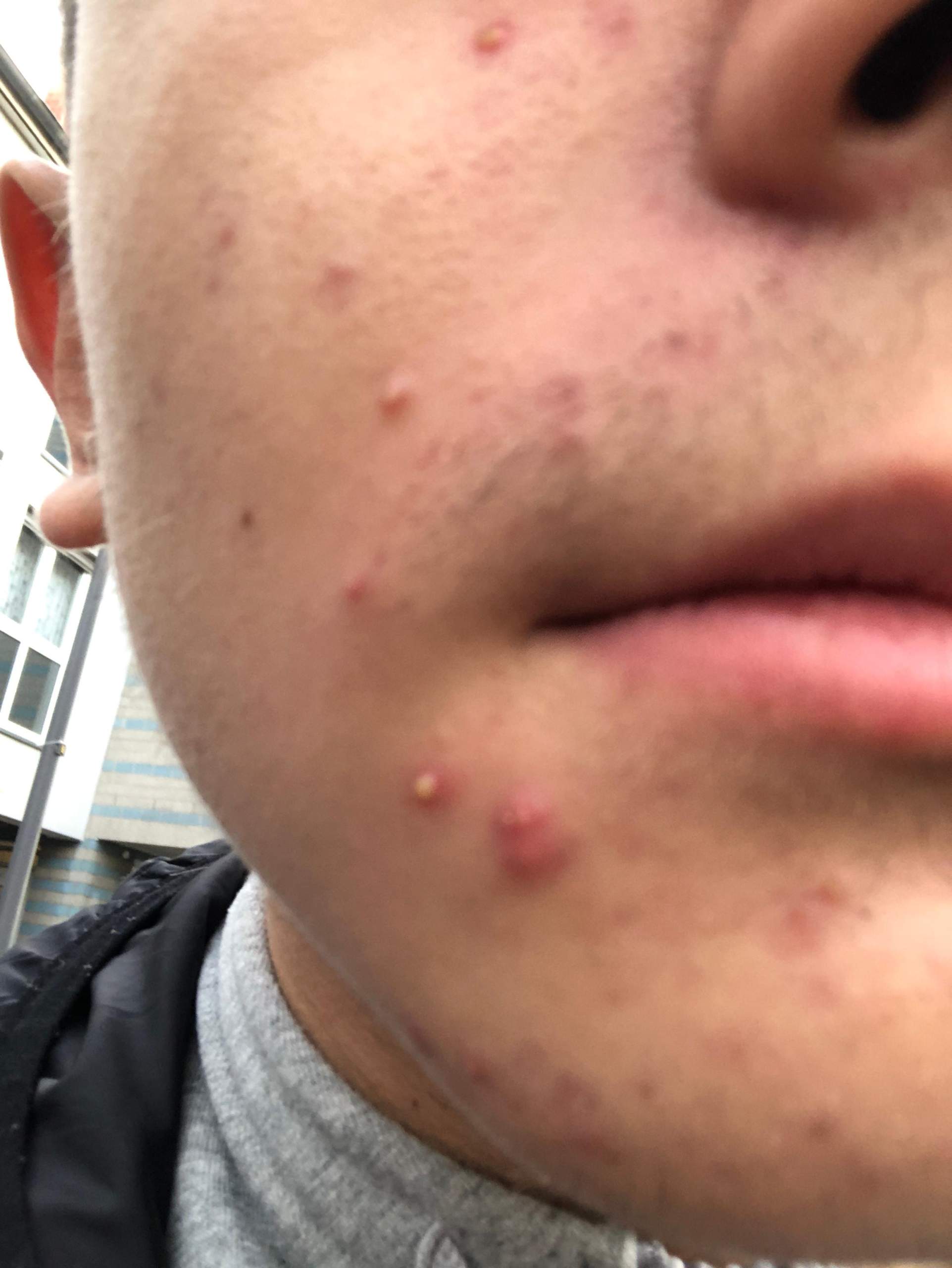 Wie werde ich diese Pickeln los? (Gesundheit und Medizin, Ernährung, Beauty)