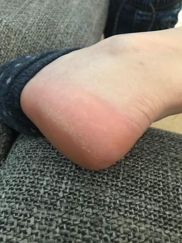 Wie Werde Ich Hornhaut Am Fuss Los Ferse Dermatologen Hautarzt