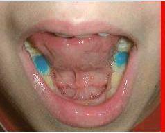 Das Blaue in den Backenzähnen sind Aufbisse - (Zahnspange, Kieferorthopädie, Aufbiss)