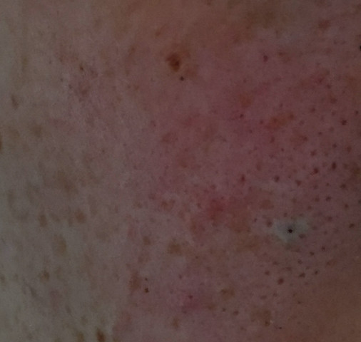 Wie wird man tiefsitzende Mitesser los? (Beauty)