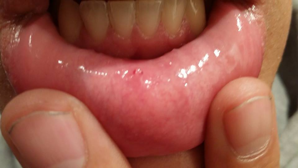 43+ Pickel Im Mundbereich Ursachen PNG