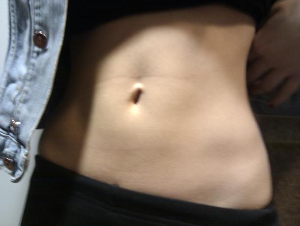 Wiederkommende Beule Im Linken Unterbauch Medizin Arzt Schmerzen Wiederkommende Beule Im Linken Unterbauch Medizin Arzt Schmerzen