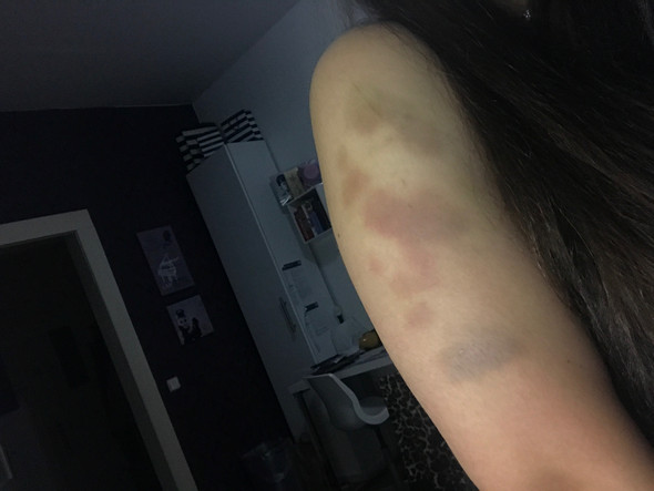 Wieso Bekomm Ich So Schnell Blaue Flecke Medizin Krankheit Blut Wieso Bekomm Ich So Schnell Blaue Flecke Medizin Krankheit Blut