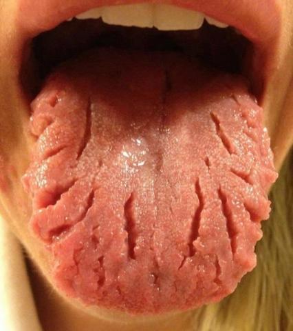 Wieso Gibt Es Immer Risse In Der Zunge Und Wovon Kommt Das Genau Mund Wieso Gibt Es Immer Risse In Der Zunge Und Wovon Kommt Das Genau Mund