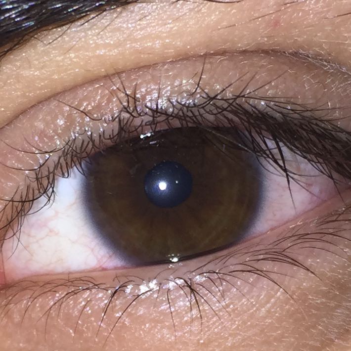 Wieso Hab ich Einen Blauen Ring Um die Iris ist es Normal Wieso Hab ich Einen Blauen Ring Um die Iris ist es Normal