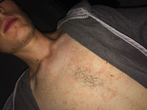 Wieso Habe Ich Einen Hautpilz Und Wie Behandele Ich Ihn Haut Wieso Habe Ich Einen Hautpilz Und Wie Behandele Ich Ihn Haut