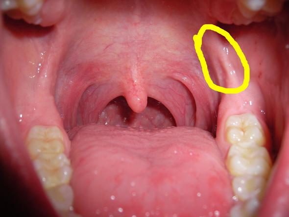 Wieso Habe Ich Nach Einer Weisheitszahn Op Gefuhle In Den Kiefer Bandern Gesundheit Schmerzen Zahne Wieso Habe Ich Nach Einer Weisheitszahn Op Gefuhle In Den Kiefer Bandern Gesundheit Schmerzen Zahne