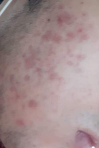 Wieso Habe Ich Nur Akne An Den Wangen Gesundheit Und Medizin Haut Pickel