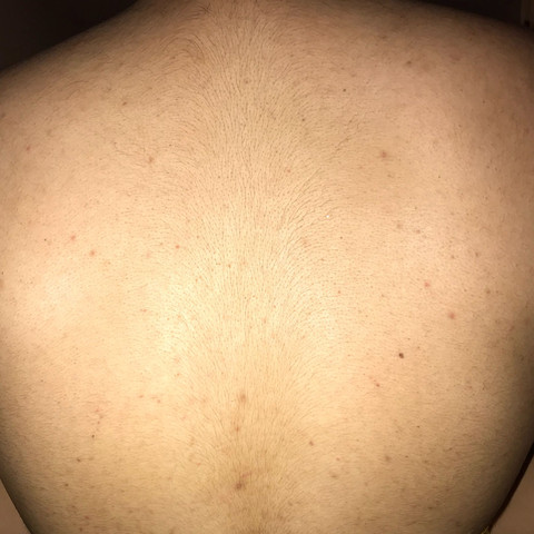 Wieso Habe Ich Soviel Akne Auf Dem Rucken Gesundheit Und Medizin Gesundheit Ernahrung Wieso Habe Ich Soviel Akne Auf Dem Rucken Gesundheit Und Medizin Gesundheit Ernahrung