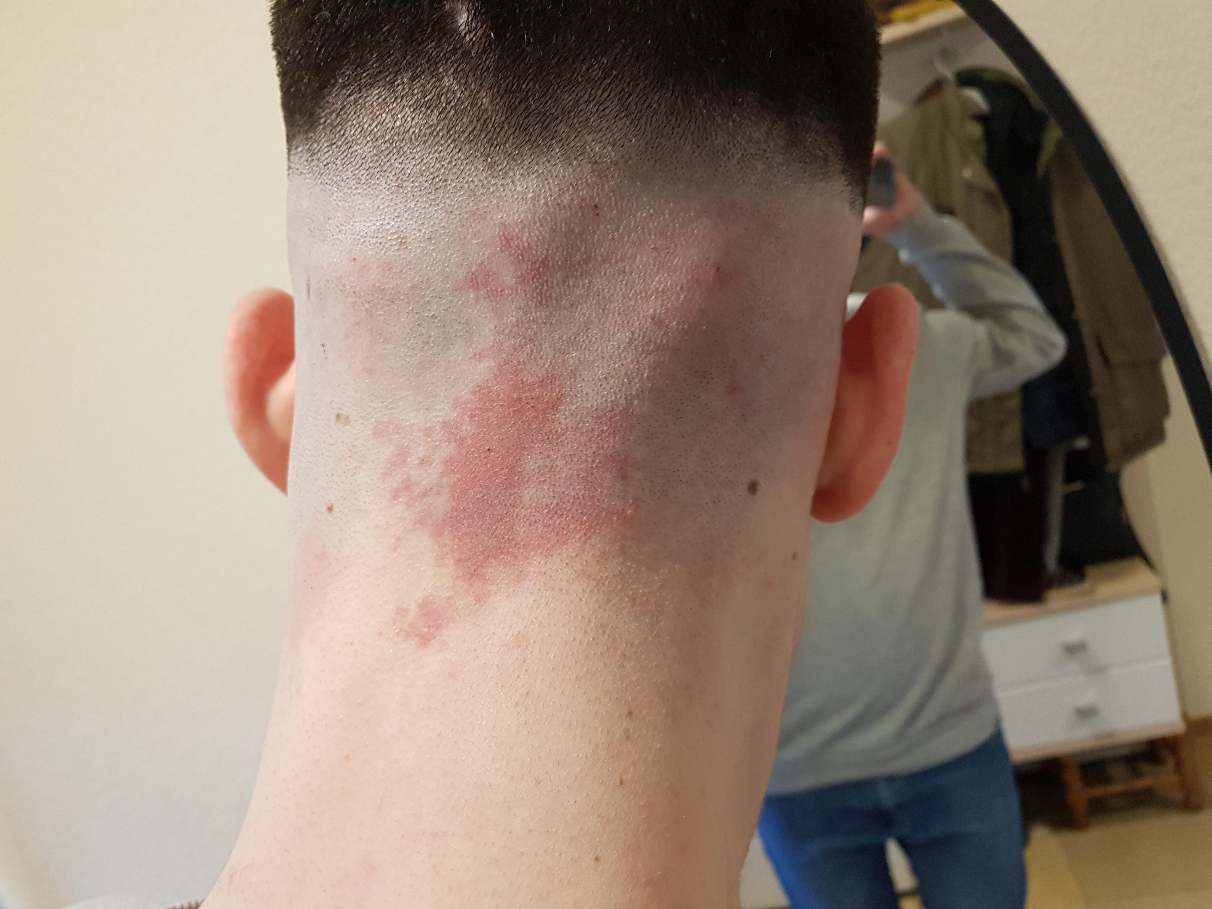 Wieso ist mein hinterkopf immer so rot? (Haare) pickel hinterkopf