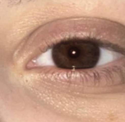 Wieso ist meine Haut um die Augen so gelb?