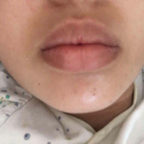 Wieso Ist Um Meinem Mund So Eine Dunkle Haut Dunkel