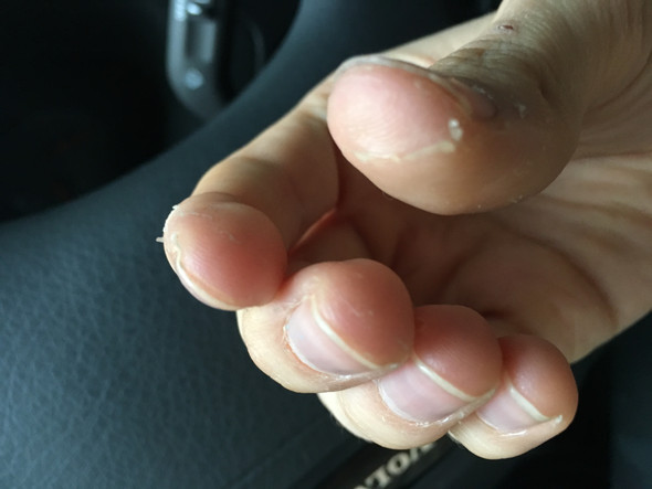 Wieso Schalt Sich Die Haut An Meinen Handen Gesundheit Und Medizin Gesundheit Ernahrung Wieso Schalt Sich Die Haut An Meinen Handen Gesundheit Und Medizin Gesundheit Ernahrung