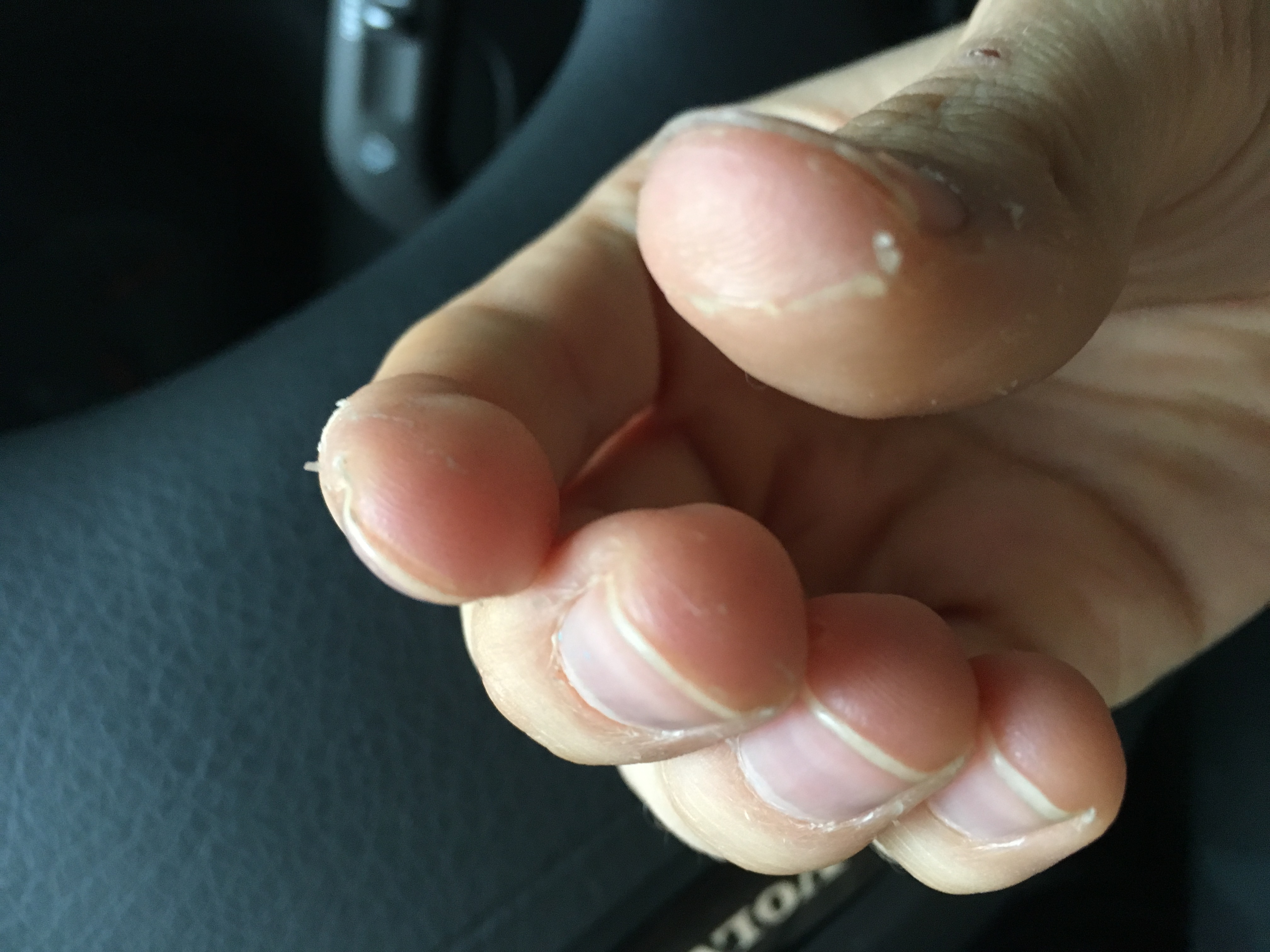 Wieso schält sich die Haut an meinen Händen? (Gesundheit, Gesundheit und Medizin, Ernährung)